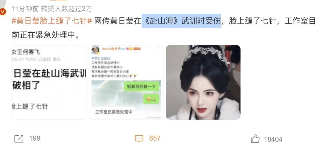 30岁女星武训意外受伤，缝了7针，撞脸李若彤！